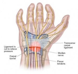 Carpal tunnel syndrome and acupuncture - Portland, Maine