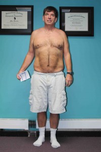 Ed Oakes Anterior View Before - Dr. Lou's Weight Loss Challenge - www.drloujacobs.com 