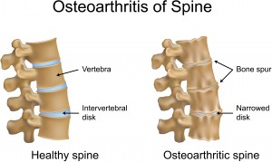 Osteoarthritis And The People Of Maine - Pain Relief In Portland - Call The Office Of Dr. Lou Jacobs at 774-6251. Jacobs Chiropractic Acupuncture