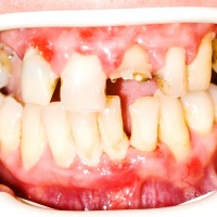 If your spine were on your face, would you take better care of it? Tooth decay and spinal decay are similar in many ways. If you don't want your spine to look like these teeth, call Dr. Lou for an evaluation of spine and nervous system function, decay, posture and future health. What does your future spine look like? Call (207) 774-6251. Dr. Lou specializes in subluxation correction.