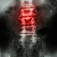 Spinal Degeneration leads to interruption in communication within nerves. Interference in communication leads to poor brain control over your entire body. This is bad, real bad.  If you already feel pain, the problem has settled in. Get help  - Call Dr. Lou (207) 774-251. Subluxation correction is our specialty.