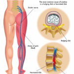 Sciatica pain during pregnancy is fairly common. Evaluation and correction of issues leading to sciatic pain is the job of the perinatal chiropractic specialist. Dr. Lou Jacobs, is that specialist and will prioritize your first visit to get you in as soon as possible. For the fastest service, Call Perinatal & Pediatric Chiropractic of Maine at (207) 553-7776 today!