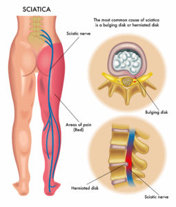 Sciatica pain during pregnancy is fairly common. Evaluation and correction of issues leading to sciatic pain is the job of the perinatal chiropractic specialist. Dr. Lou Jacobs, is that specialist and will prioritize your first visit to get you in as soon as possible. For the fastest service, Call Perinatal & Pediatric Chiropractic of Maine at (207) 553-7776 today!