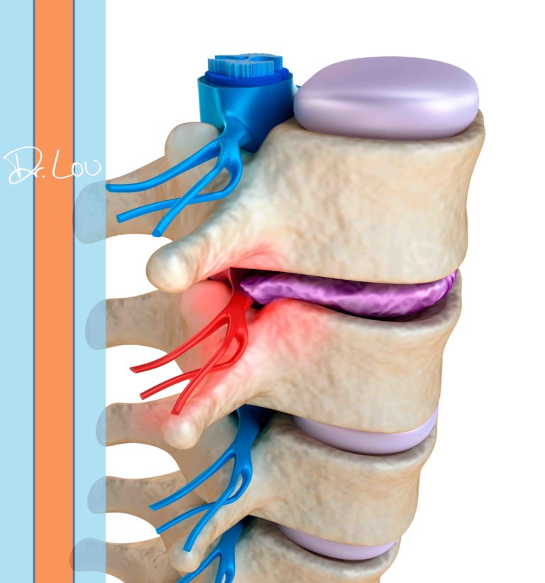 Can a chiropractor help a herniated disc? Jacobs Chiropractic Acupuncture