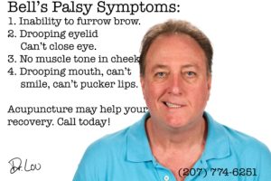 Bell's palsy seems to benefit from acupuncture. Rather than sitting around to see what happens, take action today and try to speed up results. Call Dr. Lou at (207) 774-6251