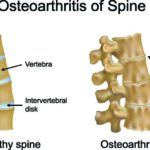Spinal Discs