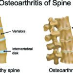 Spinal Degeneration and arthritis of the spine are the same thing! Waiting to see what happens, makes it worse.