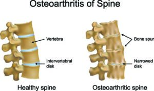 Spinal Degeneration and arthritis of the spine are the same thing! Waiting to see what happens, makes it worse.