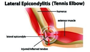 This is where lateral epicondylitis hurts! Do you have it? Do you need help? Are you at risk of losing your ability to play? Call Dr. Lou at (207) SPINAL 1