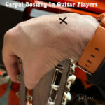 Carpal boss, or carpal bossing is not always serious. But when it is, it can destroy musical careers.