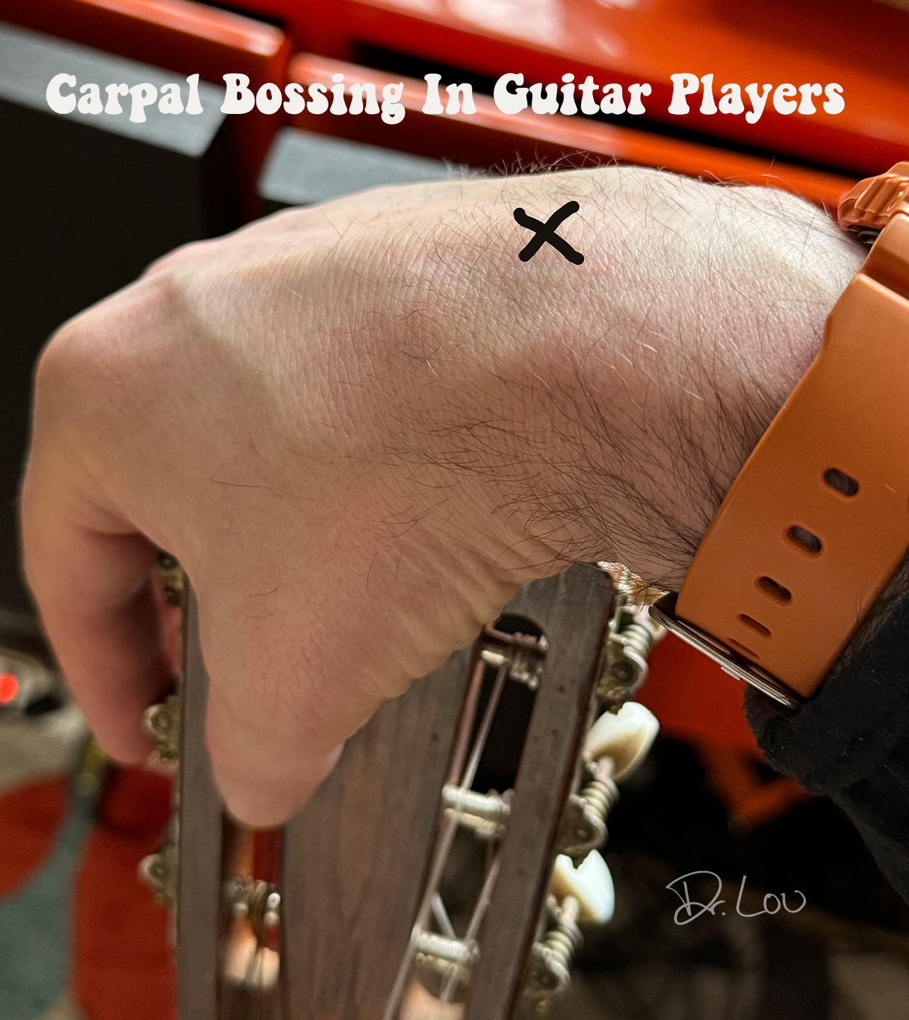 Carpal boss, or carpal bossing is not always serious. But when it is, it can destroy musical careers.